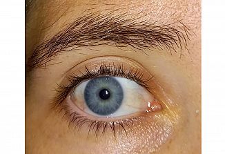 Anevrizma v naturopatiji (2)