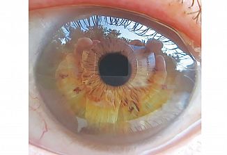 Anevrizma v naturopatiji (3)